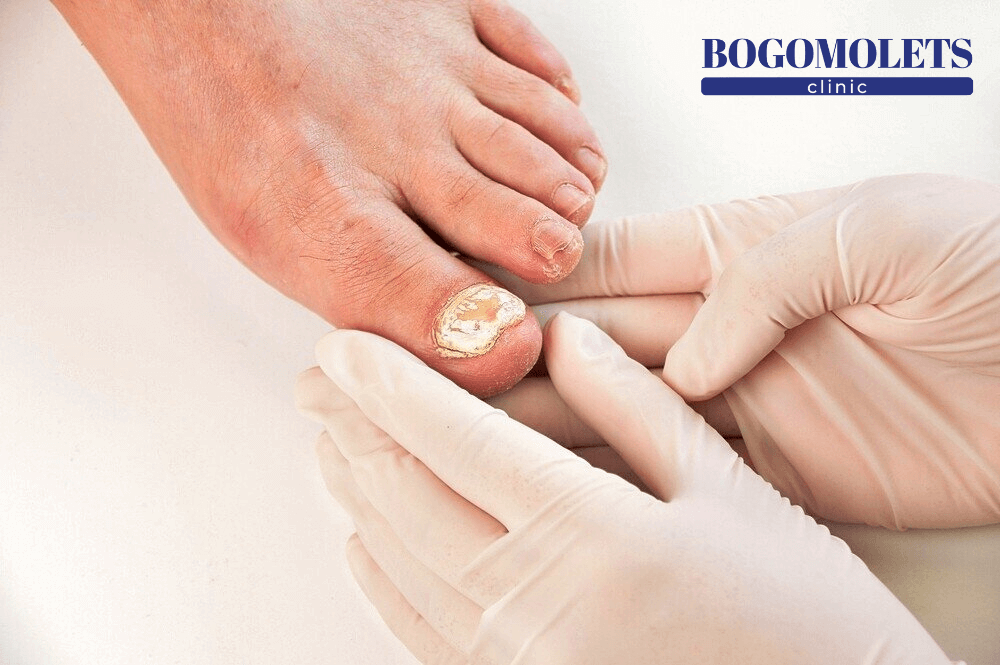 Грибок нігтів лікування фото Bogomolets Clinic