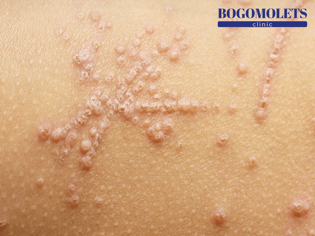 Фітофотодерматит фото Bogomolets Clinic