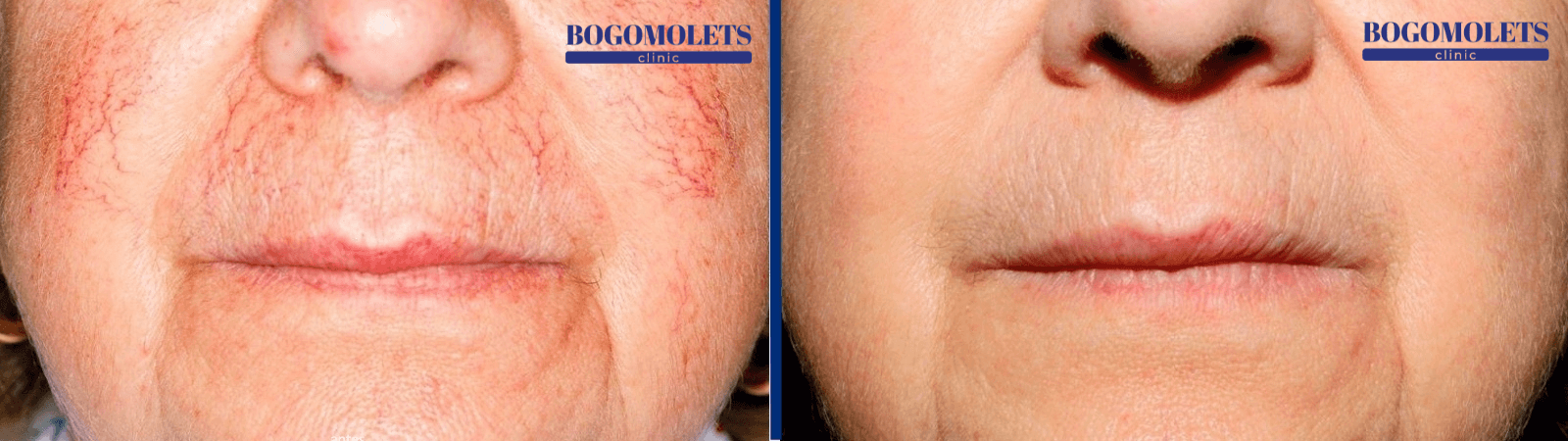 Лікування куперозу на обличчі фото до і після Bogomolets Clinic