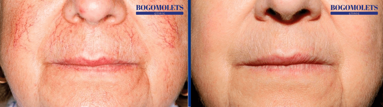 Лікування куперозу лазером фото до і після Bogomolets Clinic