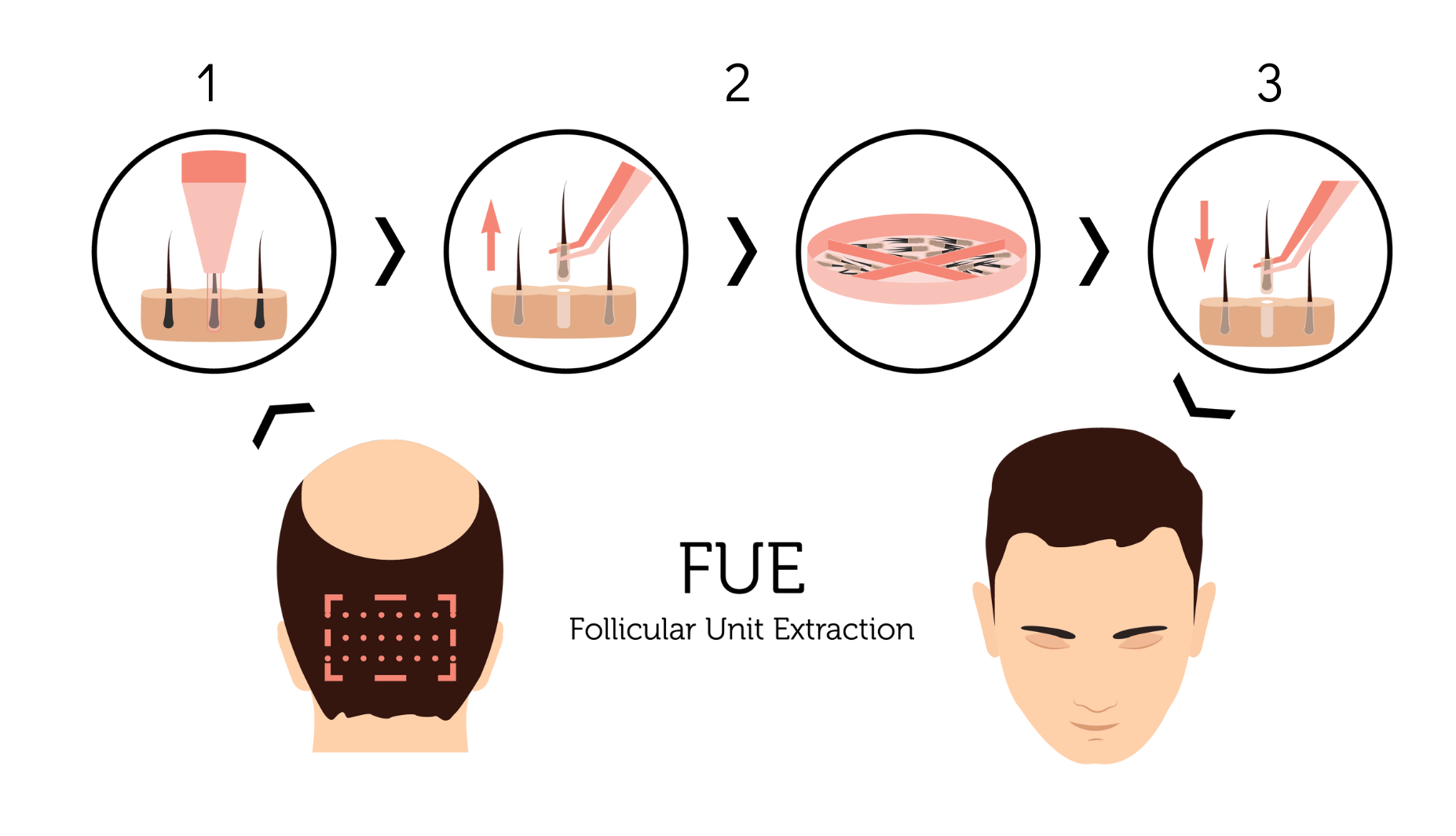 Пересадка волосся, етапи методики FUE Bogomolets Clinic