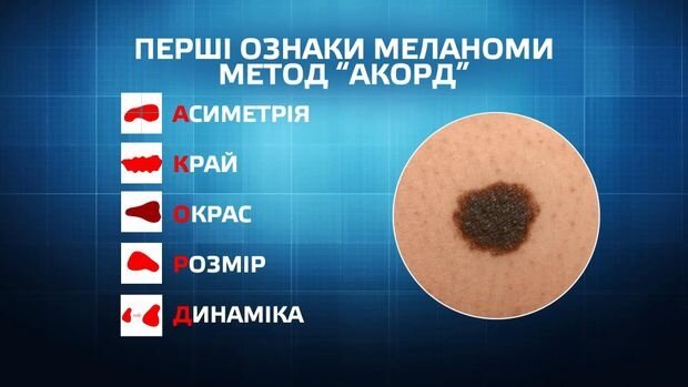 Як розпізнати меланому: поради медиків