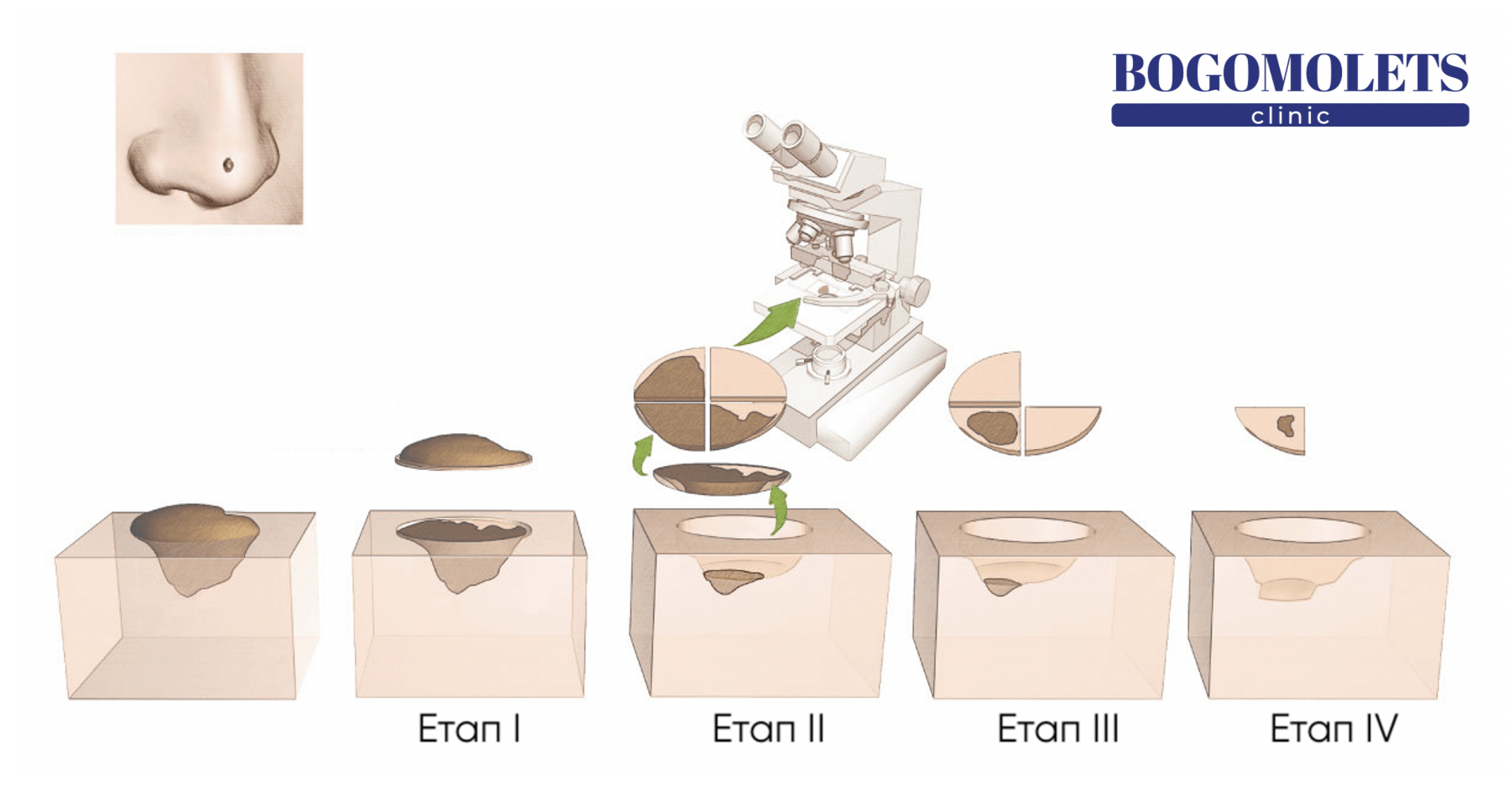 Етапи операції мос хірургії Bogomolets Clinic