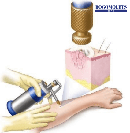 Процедура кріохірургії Bogomolets Clinic