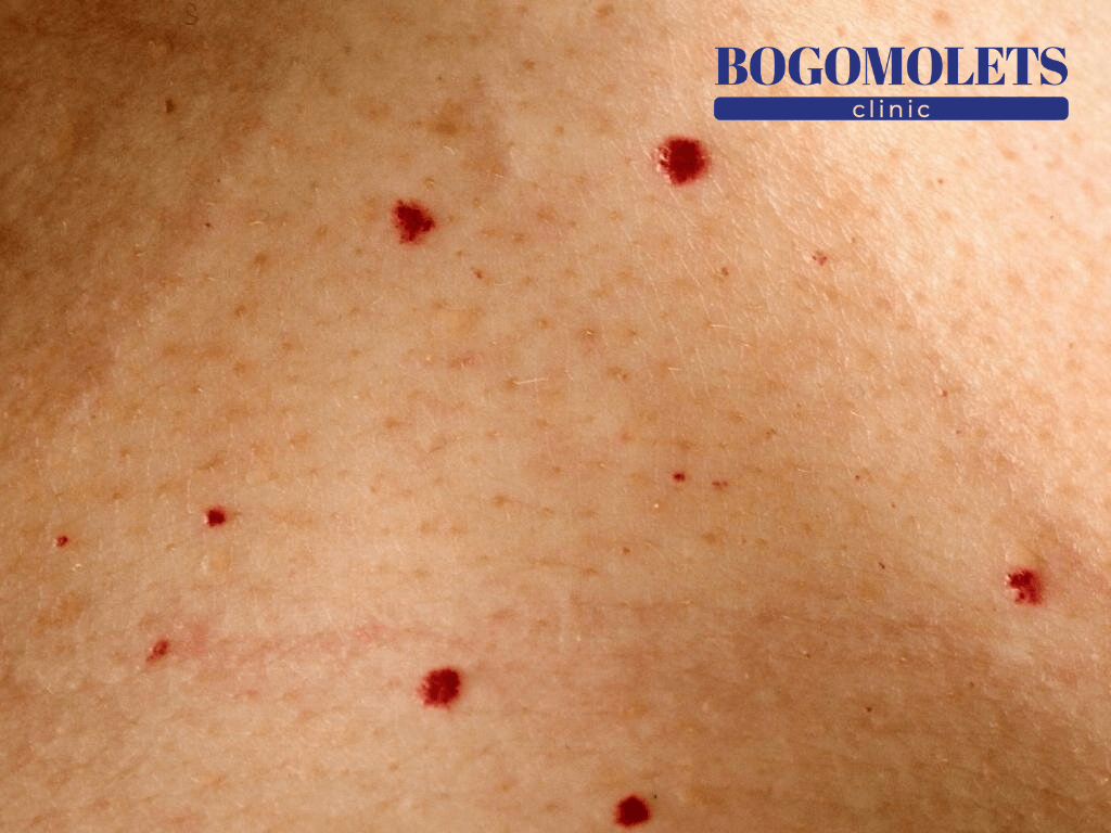 Сенільна ангіома фото Bogomolets Clinic